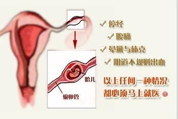 宫外孕
