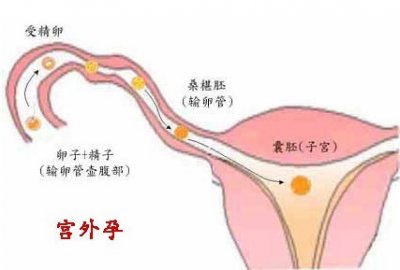 宫外孕